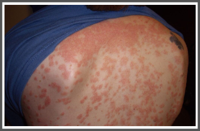 Plaque Psoriasis