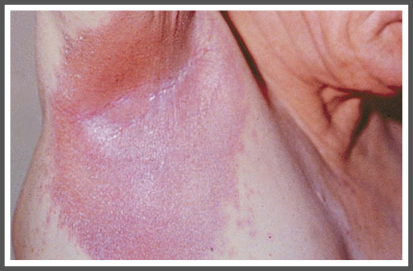 Plaque Psoriasis