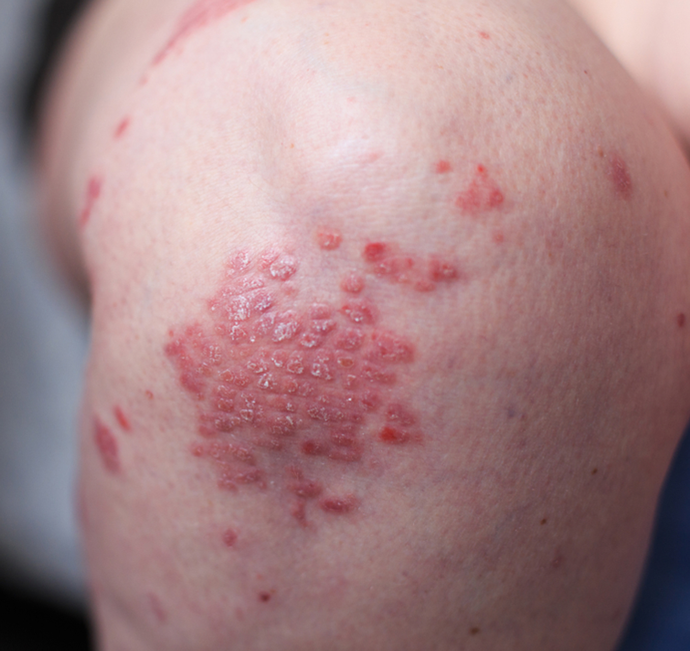 Inverse Psoriasis