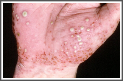 Plaque Psoriasis