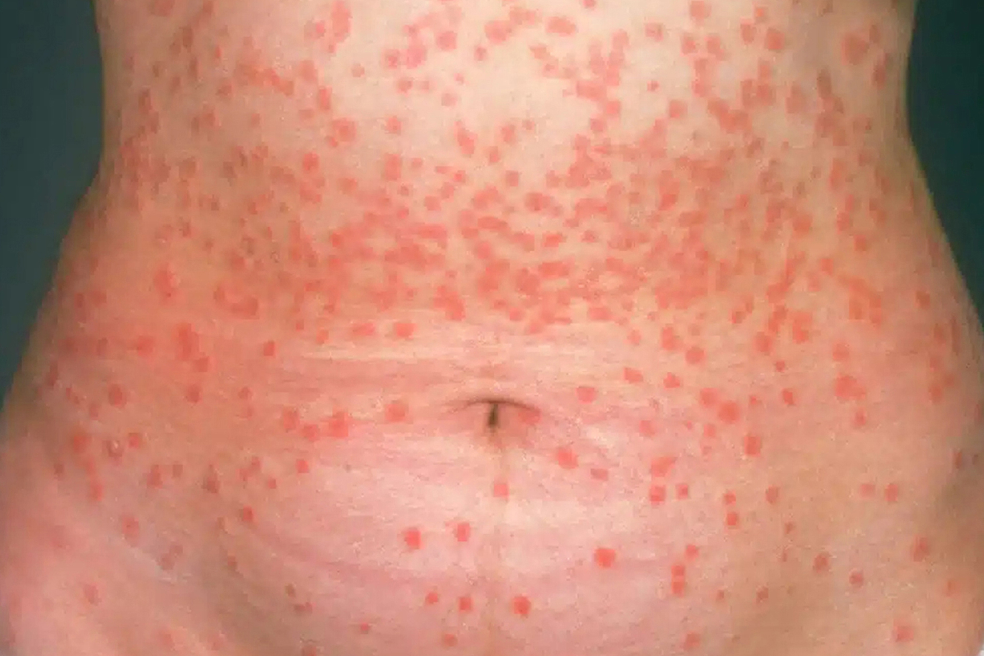 Guttate Psoriasis