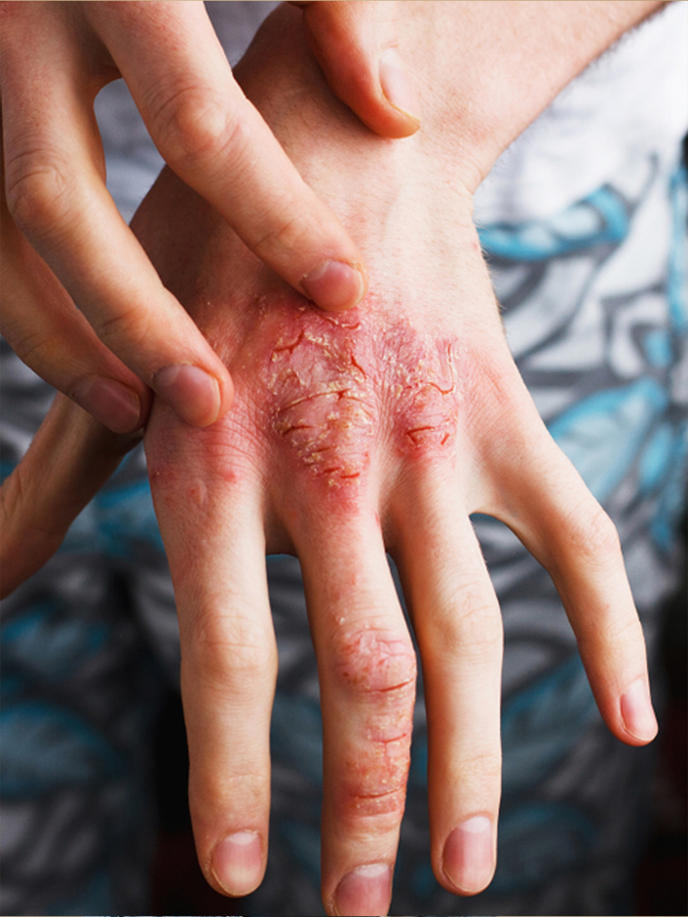 Plaque Psoriasis