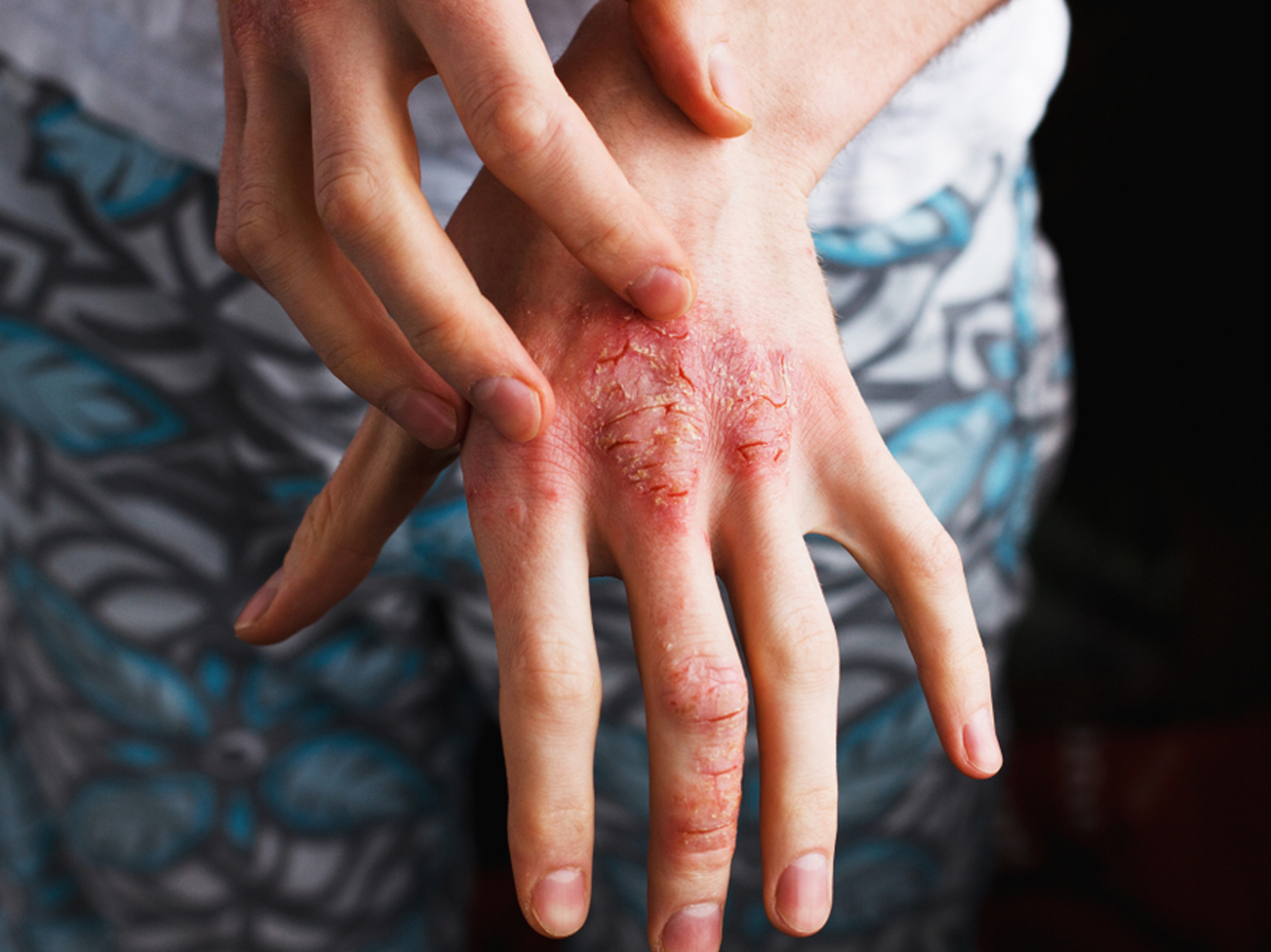 Pustular Psoriasis