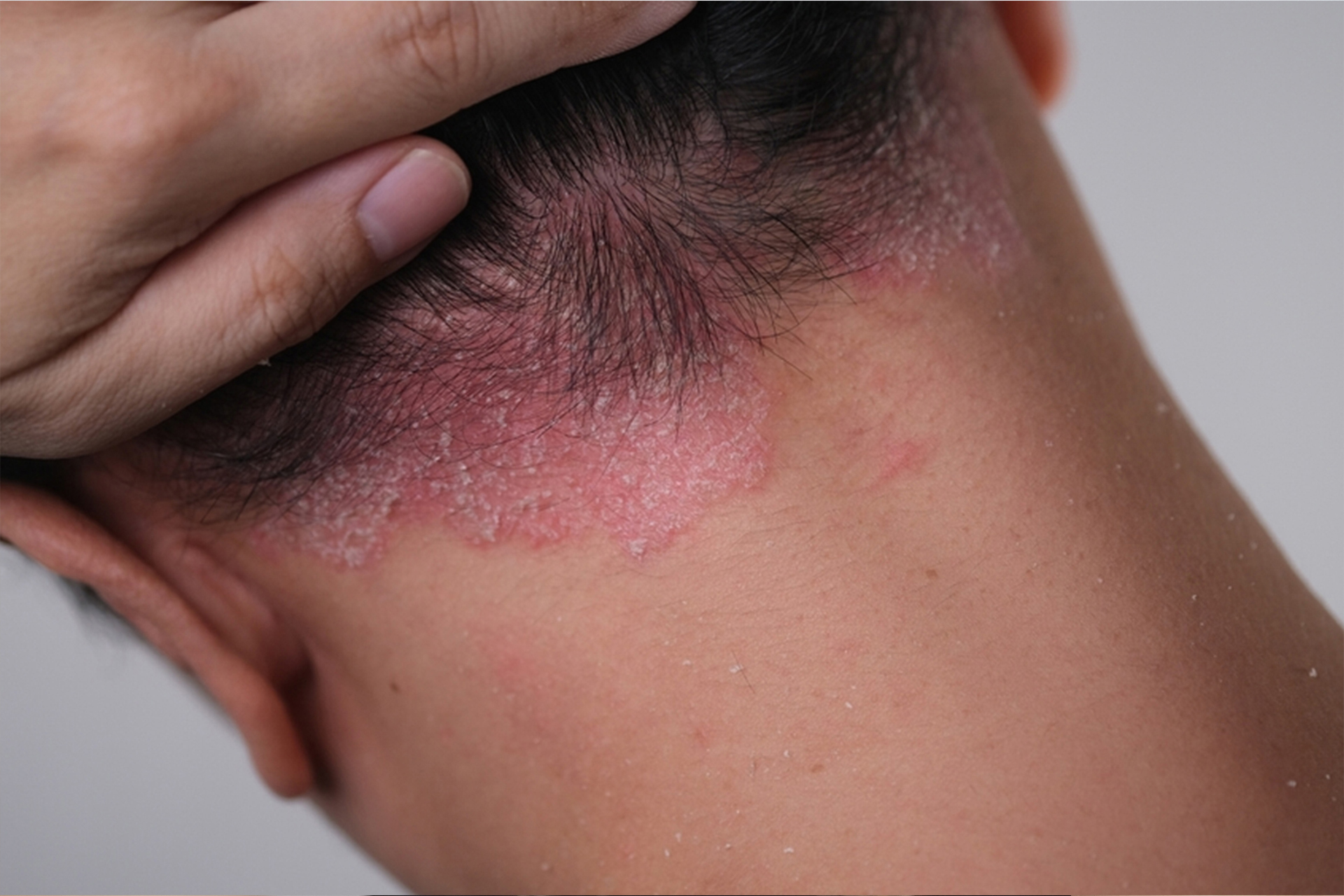 Scalp Psoriasis