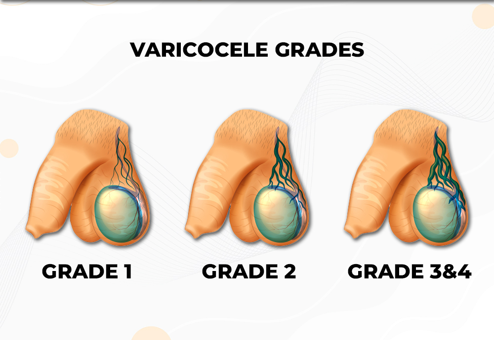 varicocele_grade