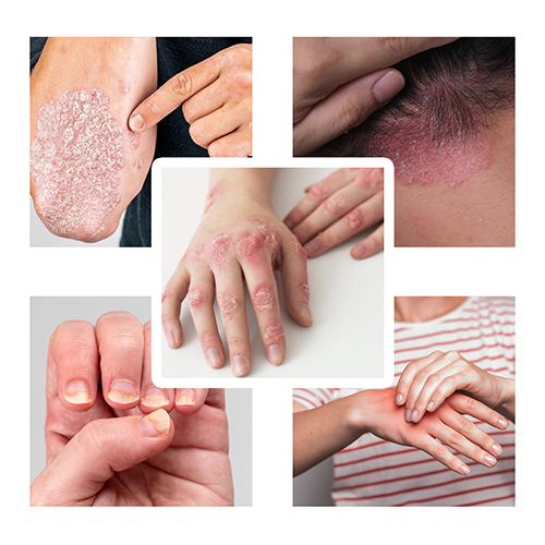 Psoriasis Symptoms