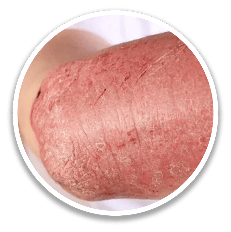 Erythrodermic Psoriasis