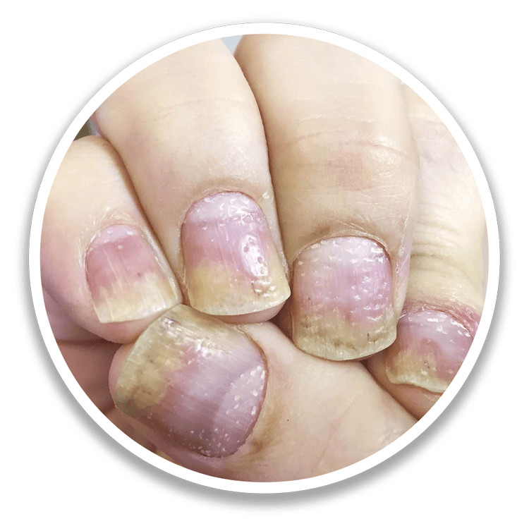 Nail Psoriasis