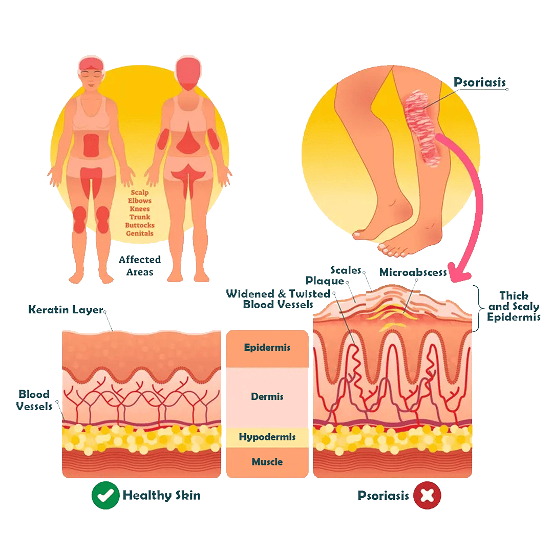 What is Psoriasis?