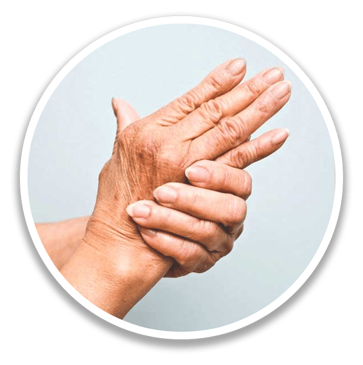 Psoriatic Arthritis