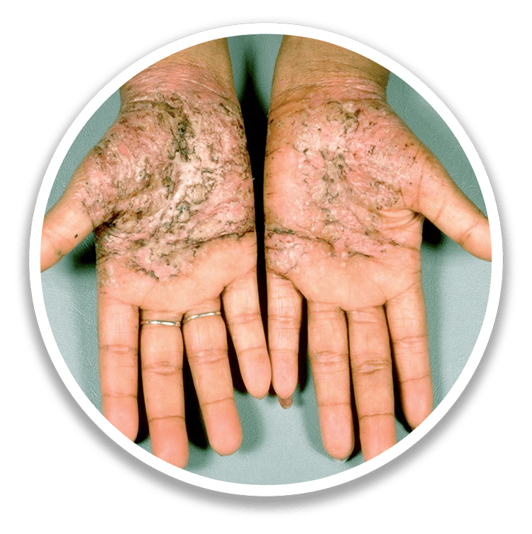 Pustular Psoriasis