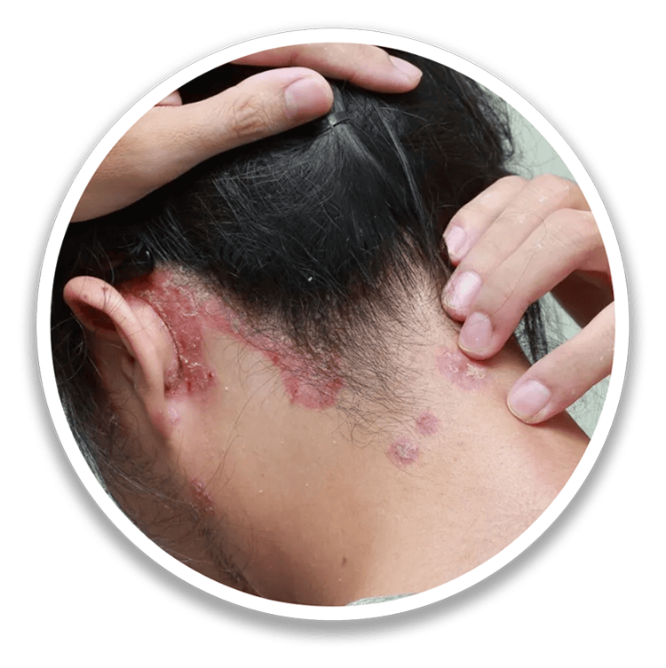 Scalp Psoriasis