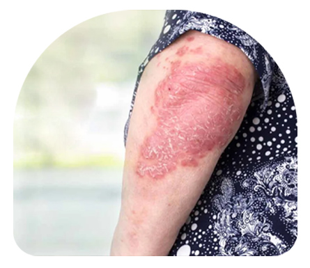 Types of Psoriasis