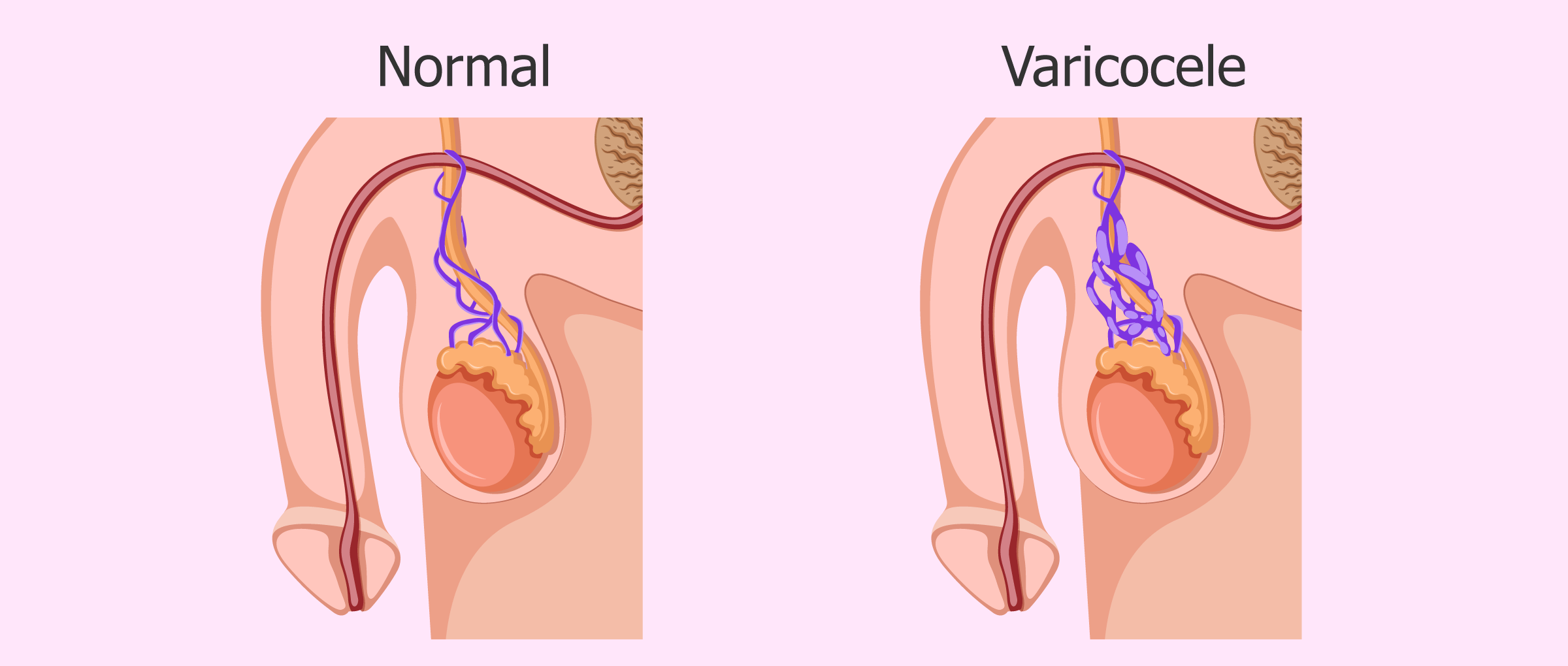 Can Varicocele Cause Erectile Dysfunction?